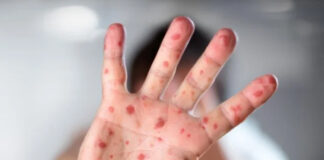 Madrid confirma 30 casos de viruela del mono y 6 regiones más con sospechosos