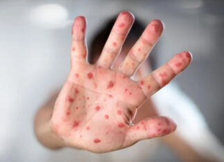 Madrid confirma 30 casos de viruela del mono y 6 regiones más con sospechosos