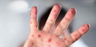 Los casos de la viruela del mono aparecerán más en todo el mundo, según la OMS