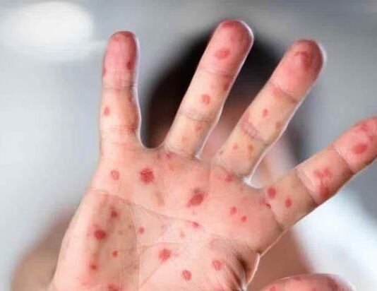 Los casos de la viruela del mono aparecerán más en todo el mundo, según la OMS
