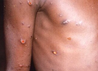 Salud descarta caso de viruela del mono en Honduras