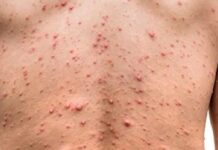 México confirma 55 casos de viruela del mono y amplía medidas preventivas