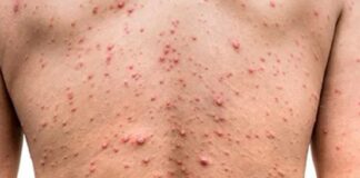 México confirma 55 casos de viruela del mono y amplía medidas preventivas