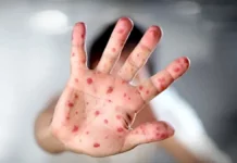 Viruela del mono ya circularía en Honduras, advierten expertos