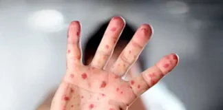 Viruela del mono ya circularía en Honduras, advierten expertos