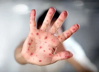 Viruela del mono ya circularía en Honduras, advierten expertos
