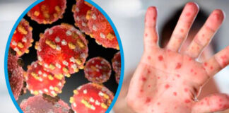 La OMS declara la emergencia internacional por el brote de viruela del mono