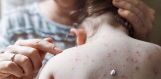 Epidemiólogo advierte que tarde o temprano la viruela del mono llegará a Honduras