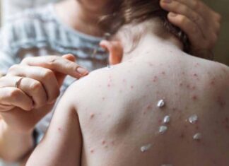 Epidemiólogo advierte que tarde o temprano la viruela del mono llegará a Honduras