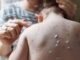 Epidemiólogo advierte que tarde o temprano la viruela del mono llegará a Honduras