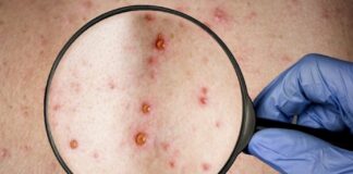 ¡Alerta! Salud confirma segundo caso de la viruela del mono en Honduras