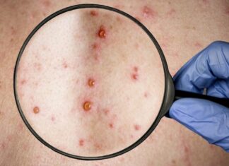 ¡Alerta! Salud confirma segundo caso de la viruela del mono en Honduras