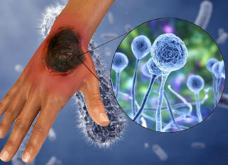 Honduras confirma otro caso de hongo negro y ya suman 42 en el país