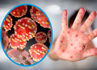 La OMS levanta la emergencia internacional por la viruela símica tras 10 meses de alerta