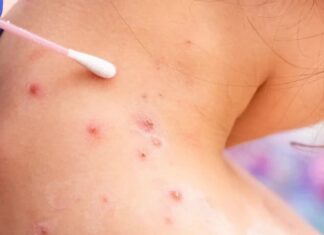 La Sesal descarta un cuarto caso de la viruela del mono