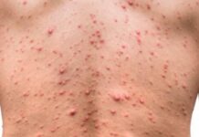 Confirman el cuarto caso de viruela del mono en Honduras