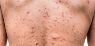 Confirman el cuarto caso de viruela del mono en Honduras