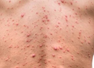 Salud contempla habilitar una línea especial de atención para pacientes con sospechas de viruela del mono