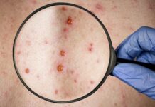 EE. UU. crea un grupo de respuesta ante la propagación de la viruela del mono