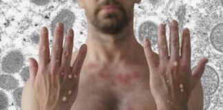 Salud confirma dos nuevos casos de viruela del mono en Honduras