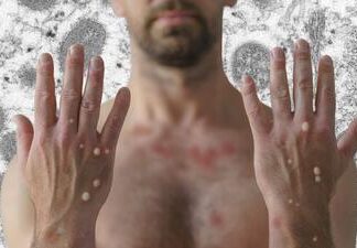 Salud confirma dos nuevos casos de viruela del mono en Honduras