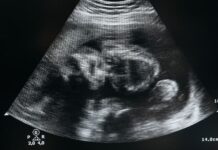 ¡Insólito! Médicos encuentran fetos en el vientre de una recién nacida