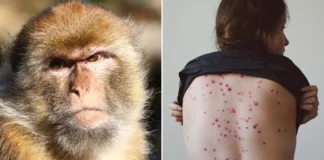 La OMS rebautiza la viruela del mono como «mpox» para evitar estigmatización