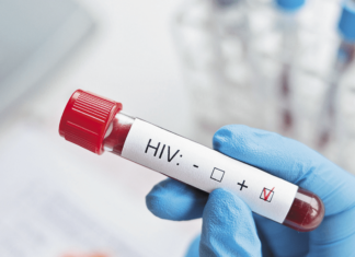 El sida mató a 650,000 personas en 2021, un 5,79% menos que el año anterior