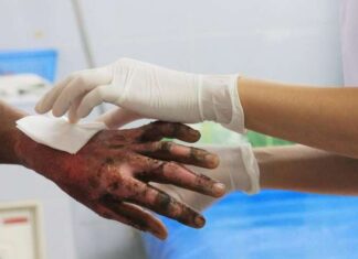 Entre 3 y 4 niños ingresan semanalmente con quemaduras al Hospital Escuela