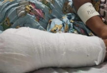 Joven pierde tres dedos al explotarle un mortero en San Pedro Sula