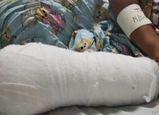 Joven pierde tres dedos al explotarle un mortero en San Pedro Sula