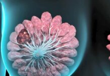 Cáncer de mama: nuevo método para buscar el mejor fármaco para cada paciente