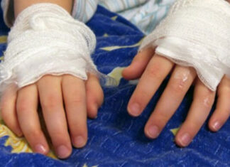 Ingresa a Fundaniquem una menor con quemaduras por pólvora