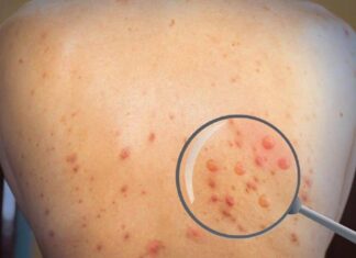 Autoridades sanitarias confirman un nuevo caso de viruela del mono en el país