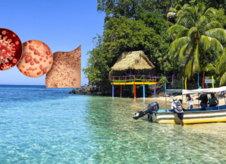 Islas de la Bahía registra el primer caso de viruela símica