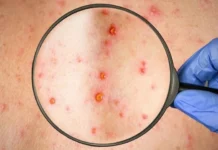 Regional Sanitaria del Departamento de Islas de la Bahía confirma segundo caso de viruela símica en Roatán