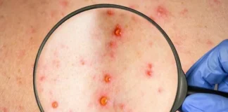 Honduras registra cuatro nuevos casos de viruela símica y suma 28 en 2023
