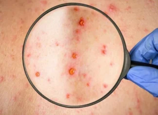 Honduras registra cuatro nuevos casos de viruela símica y suma 28 en 2023