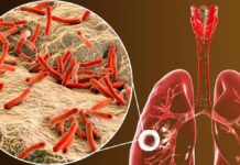 Alertan de una alta incidencia de casos de tuberculosis, en cárceles de Honduras