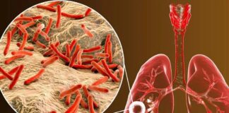 Alertan de una alta incidencia de casos de tuberculosis, en cárceles de Honduras