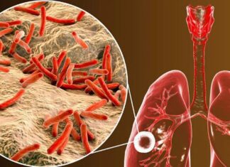Alertan de una alta incidencia de casos de tuberculosis, en cárceles de Honduras