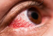 Alertan sobre el aumento de casos de conjuntivitis en el país a causa de la contaminación ambiental