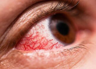 Alertan sobre el aumento de casos de conjuntivitis en el país a causa de la contaminación ambiental