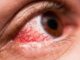 Alertan sobre el aumento de casos de conjuntivitis en el país a causa de la contaminación ambiental