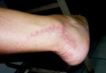 Detectan 16 casos de lepra en Choluteca