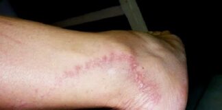 Detectan 16 casos de lepra en Choluteca