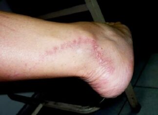 Detectan 16 casos de lepra en Choluteca