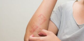 Aumentan las enfermedades de la piel por las altas temperaturas en la zona sur de Honduras