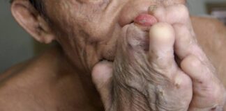 Alarma en Honduras, tras la confirmación de 16 casos de lepra en la zona sur