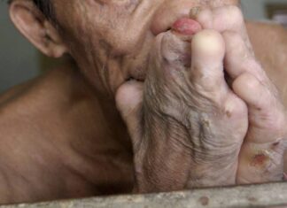 Alarma en Honduras, tras la confirmación de 16 casos de lepra en la zona sur